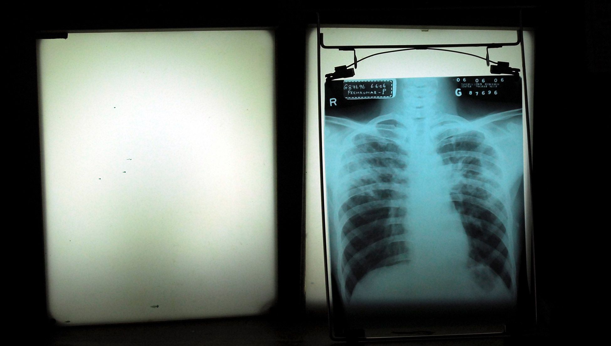 Studying tuberculosis in India, I saw the problem with cures | Psyche