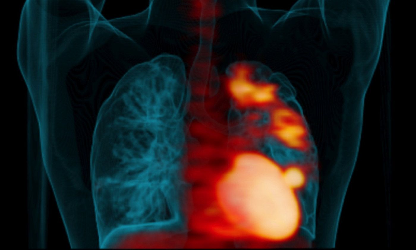 dead space examples diseases lungs dead space examples diseases lungs